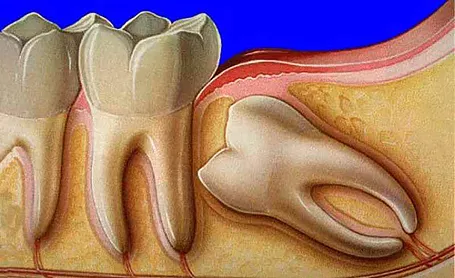 Removal of Impacted Tooth